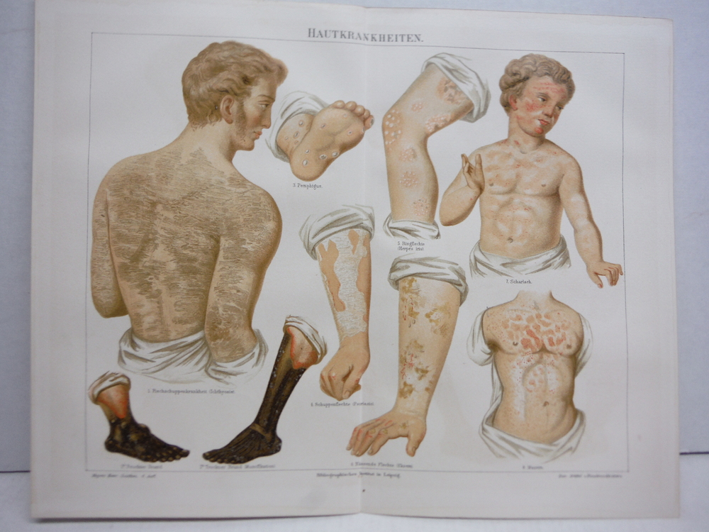 Meyers Antique  Chromolithograph  HAUTKRANKHEITEN (Skin Diseases)  (1890) 