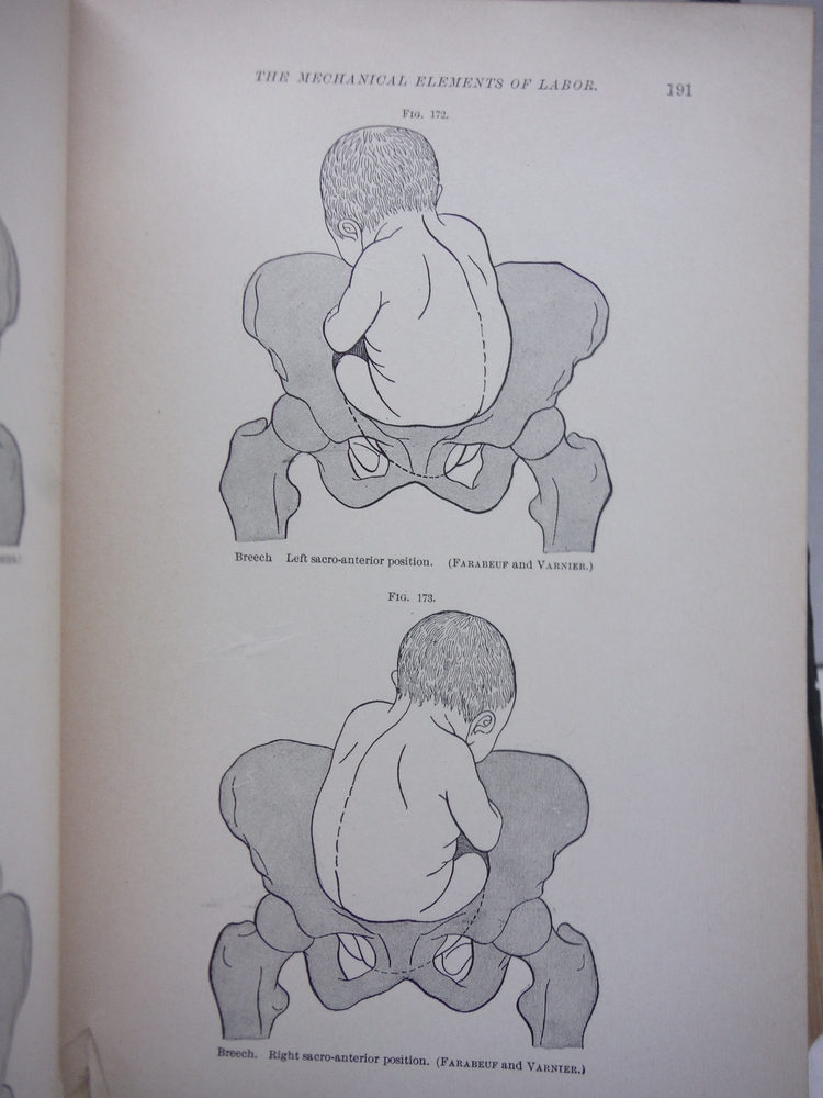 Image 3 of The Practice of Obstetrics By American Authors