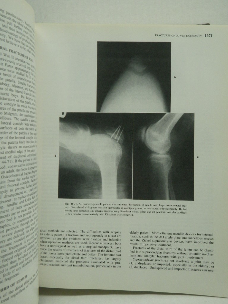 Image 3 of Campbell's Operative Orthopaedics  Volume 3